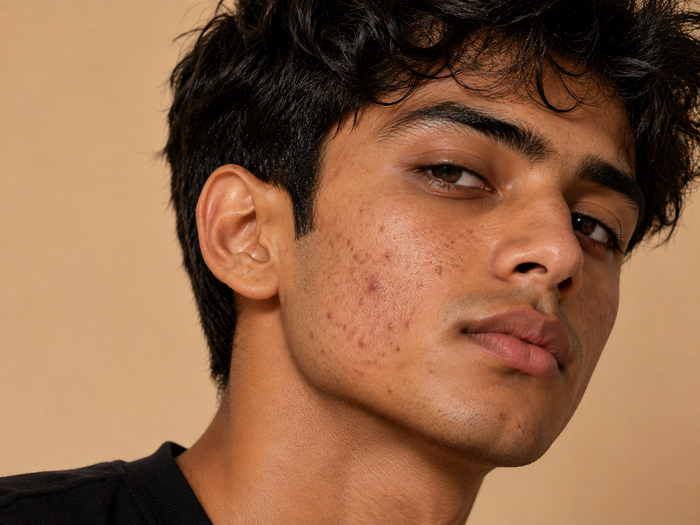 Acne